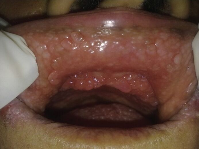 papilómy v ústach