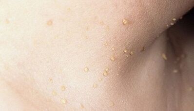 riziko vzniku papilomatózy na krku