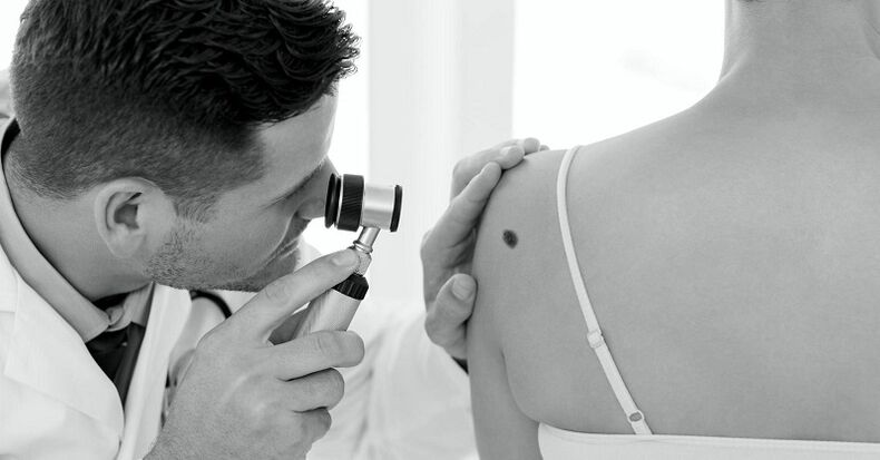 špecialista diagnostikuje typ bradavice